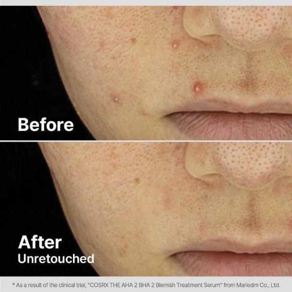 סרום AHA\BHA טיפולי מהיר וממוקד לטיפול בפגמי עור 50 גרם | COSRX