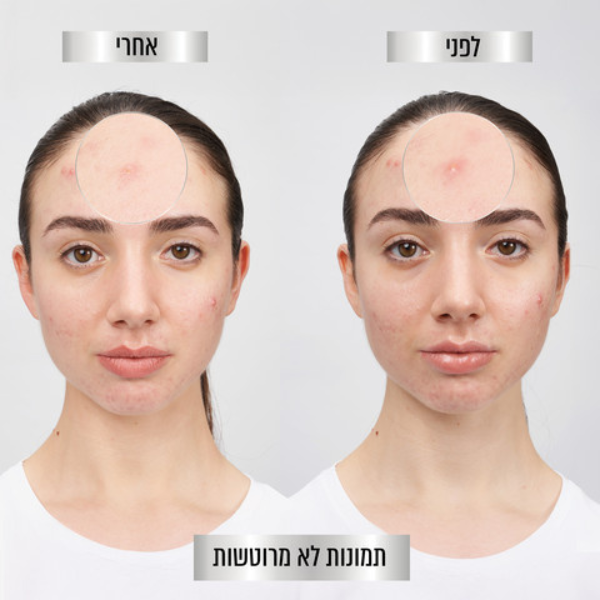 גרנייה מדבקות לטיפול בפצעונים