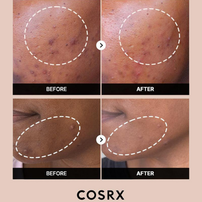 סרום אלפא ארבוטין 2% לטיפול בפיגמנטציה וצלקות אקנה | 50 מ"ל | COSRX