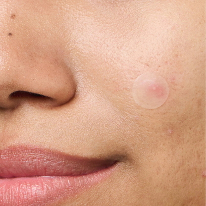 מדבקות שקופות לטיפול בפצעונים לשעות היום | 24 יחידות | SeboCalm