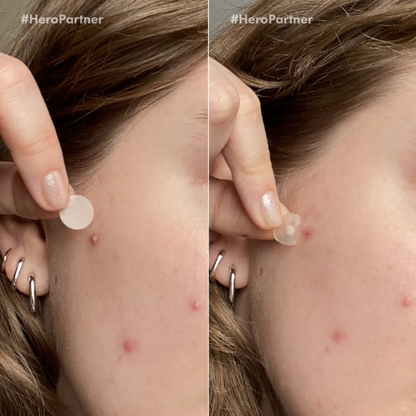 מדבקות מייטי פאץ' לטיפול בפצעונים לשימוש יום ולילה | 12 יחידות | SeboCalm